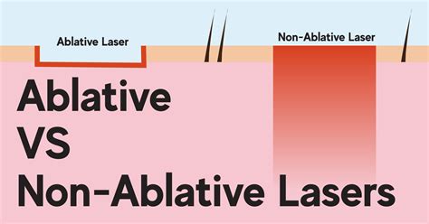 laser no chanel|Ablative Lasers vs. Non.